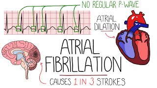 Atrial Fibrillation Made Easy Complete Overview [upl. by Mellins269]