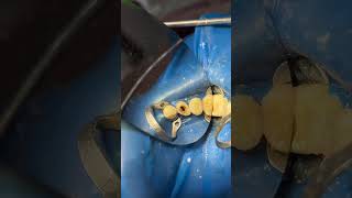 thedentalviews dentalprocedure dentist dentalpractice dentaltreatment dentalcare [upl. by Irama]