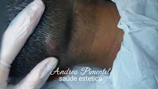 CISTO SEBACEO OU EPIDERMICO quotAndrea Pimentel neuroestéticaquot [upl. by Ilrebma47]