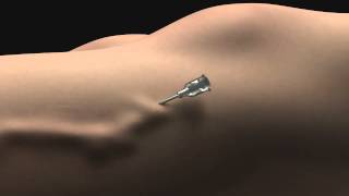 No  Knife Endovenous Laser  Animation of Scarless Varicose Vein Treatment [upl. by Eanehs910]