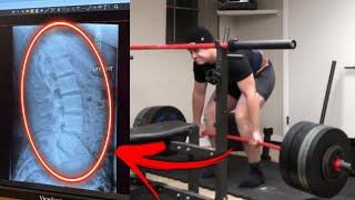 Deadlifts amp Back Pain The Myths Debunked [upl. by Uase]