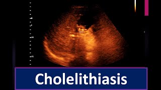 Cholelithiasis  Thickened sludge within the Gall Bladder lumen  Enlarge prostate [upl. by Sackman]