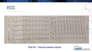 3 17 1 Syndrome coronarien aigu  diagnostic et prise en charge initiale [upl. by Whipple]