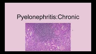 Chronic Pyelonephritis [upl. by Augie85]