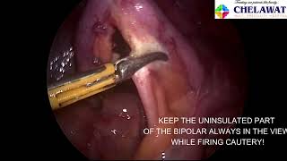 APPENDIX WITH BIPOLAR VOICE OVER TIPS AND TRICKS FOR YOUR FIRST APPENDECTOMY [upl. by Sillaw]