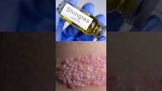 How Chicken Pox Leads to Shingles Herpes Zoster chickenpox shingles vaccine shorts DMC [upl. by Ikiv]