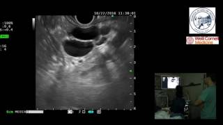 Endoscopic Ultrasound EUS for differential diagnosis in pancreas at Hospital Juárez Mexico City [upl. by Bernadene]