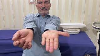 Right arm pronator drift following stroke [upl. by Sivat]