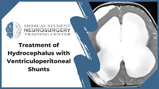 Treatment of Hydrocephalus with Ventriculoperitoneal Shunts [upl. by Dhiren550]