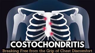 Costochondritis Breaking Free from the Grip of Chest Discomfort [upl. by Deckert732]