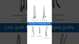 Potential Graft and Native Hair Loss in FUE Hair Transplants hairtransplant [upl. by Yevrah]