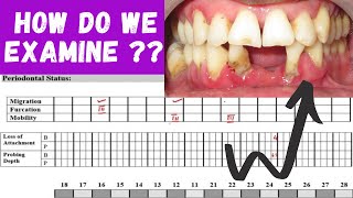 PERIODONTAL EXAMINATION ‖ HOW TO EXAMINE PERIODONTITIS PATIENT  ‖ PERIO HUB ‖ Dr SNEHA [upl. by Etnomaj368]