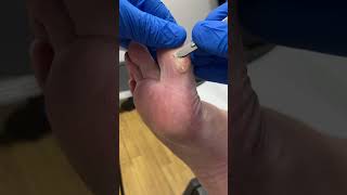 Watch Dry Big Toe Callus Vanish Expert Aussie Podiatrist  Work with Scalpel [upl. by Aisyram96]