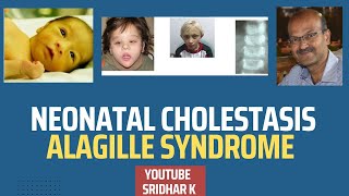 Alagille syndromewhat is Watson Alagille Syndrome neonatalcholestasis alagillesyndrome [upl. by Arsi]