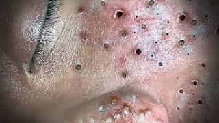 Toltal Best blackheads by Loan Nguyen No ads [upl. by Kynan597]