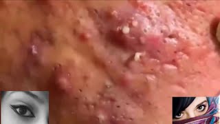 Severe Cystic Acne Infection Treatment Young Age [upl. by Aphra]