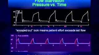 Mechanical Ventilation Waveform Analysis [upl. by Opportina383]