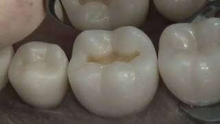 Class I Composite Preparation amp Restoration  Operative Dentistry [upl. by Tulley79]