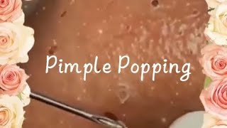 Pimple amp Blackheads Popping  10 [upl. by Petula]