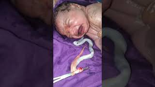 Vernix lot of 2 meters Newborn baby nurse and doctor cleaning it with soap and spinal cords cutt [upl. by Anavoj]