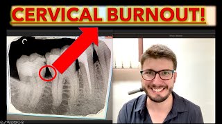 Cervical Burnout or Caries How to Know theories of dental caries in teeth cavity ICDAS x ray [upl. by Benenson]