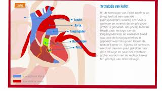 Aangeboren hartafwijking Tetralogie van Fallot  Wilhelmina Kinderziekenhuis [upl. by Luhar]