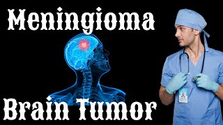 Brain Tumor  Meningioma Detailed information about treatments prognosis survival rate etc [upl. by Devad]