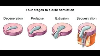 Physiotherapy for Intervertebral Disc prolapse StayHome and study WithMe [upl. by Airtened]