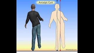 Antalgic Gait  Definition causes characteristics Disease association Diagnosis Treatment [upl. by Deva607]