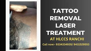 Tattoo removal laser treatment at hlccs ranchicall now 9334334935 tattooremoval tattoo laser [upl. by Averi]