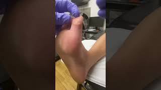 Witness this Aussie Podiatrist work wonders on big toe callus FootCare PodiatryMagic [upl. by Traci]