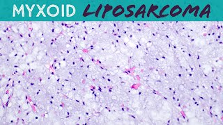 Myxoid Liposarcoma explained in 5 minutes basic soft tissue pathology sarcoma pathologists [upl. by Daphne]