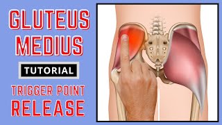 Trigger Point Release  Gluteus Medius [upl. by Cicenia]