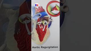 Aortic Regurgitation  shorts medicineknowledgehindi [upl. by Tanya]