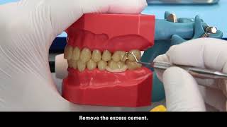 RelyX U 200 cementation on zirconia crown [upl. by Nahem919]