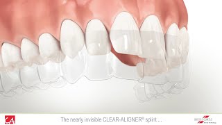 Treatment of Malocclusion Teeth with Invisible Splint [upl. by Annoif470]