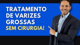 Veja esses Resultados no tratamento de varizes grossas SEM CIRURGIA [upl. by Ardnuhs]