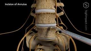 Anterior Lumbar Discectomy with Posterior Instrumentation [upl. by Ettore288]