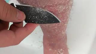 Shaving off the Greyscale Psoriasis [upl. by Paulie]