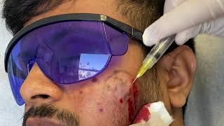 Subcision for Acne Scars [upl. by Gnagflow]