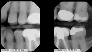 Tips and Tricks for Bitewing XRays [upl. by Centonze764]