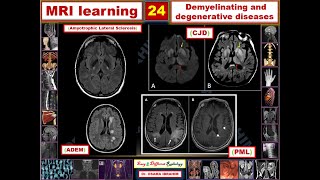 MRI learning 24 Demyelination and degenerative diseases [upl. by Theobald]