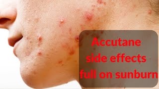 Accutane side effects sunburn [upl. by Oriane]