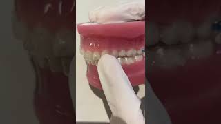 Class II Elastics with Invisalign [upl. by Ellednahs]