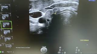 Thyroid atrophy  Hypoplasia  Small Thyroid  Ultrasound [upl. by Honeywell454]