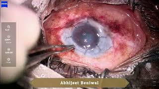 Optical penetrating keratoplasty in Xeroderma Pigmentosum [upl. by Sorensen]