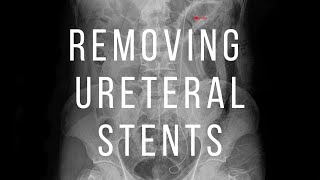 Removing Ureteral Stent in 15 Seconds shorts [upl. by Shing]