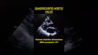 Quadricuspid Aortic Valveaortaaorticaorticaneurysm aorticstenosisrheumaticpericarditisecho [upl. by Cordell785]