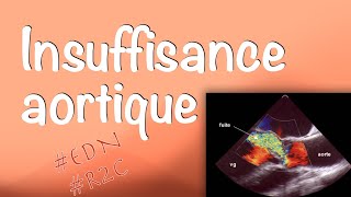 Insuffisance aortique  Valvulopathies cardiaques item 233 des EDN [upl. by Teodoro]