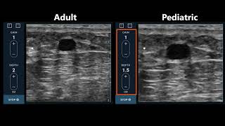 Getting to Know the EchoNous Vein Part 2 [upl. by Sivia629]